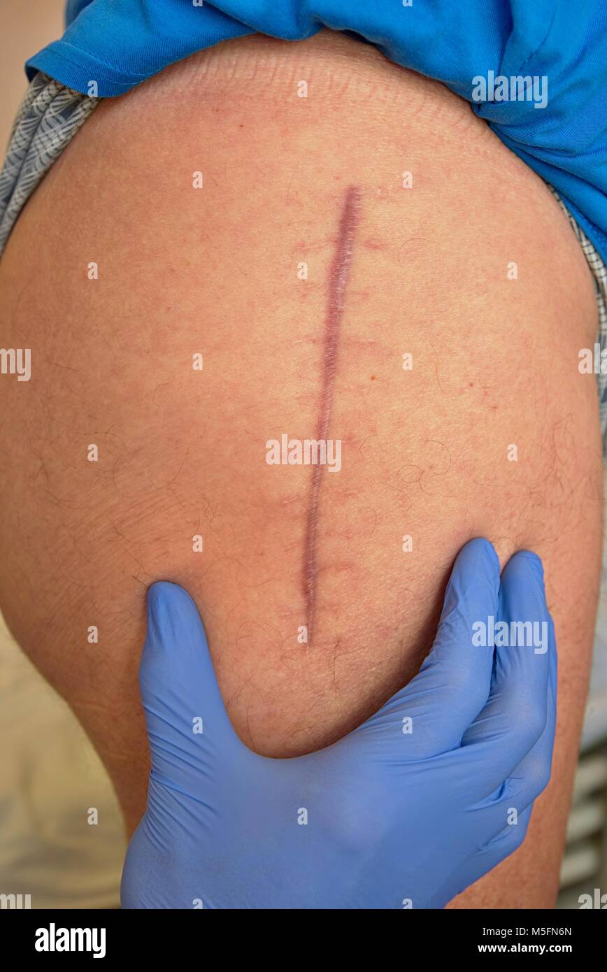 Medizin Arzt prüfen Narbe. Patienten Hüftgelenk, die durch Arthritis betroffen war und Ersatz durch ein künstliches Gelenk. Detail der Haut nach replaci Stockfoto