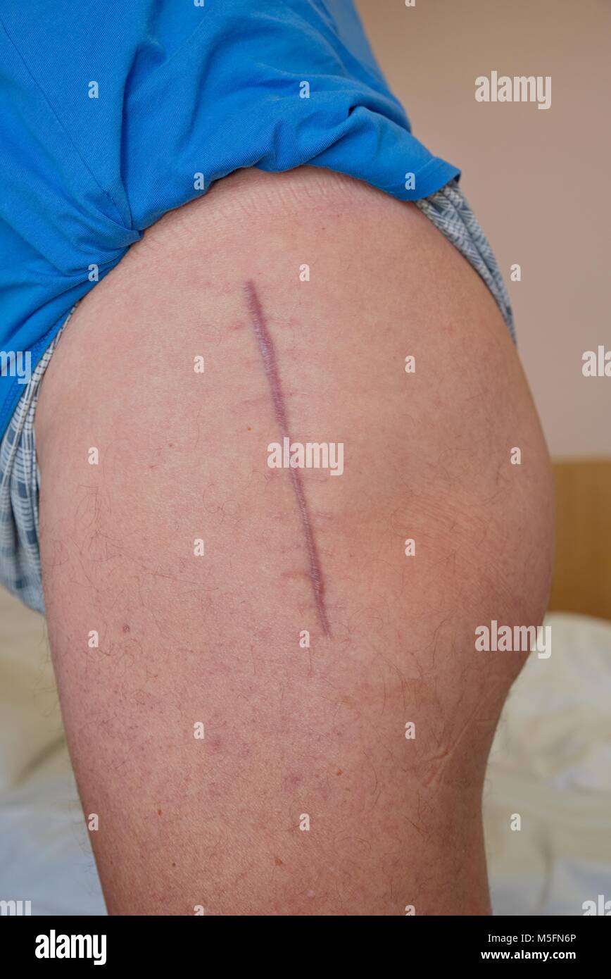 Ein Jahr alten Narbe nach der Operation des Hftgelenkes. Austausch der  zerstrten Hftgelenk fr die hftendoprothese Stockfotografie - Alamy