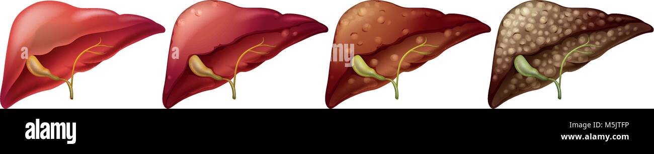 Verschiedenen Phasen der menschlichen Leber Abbildung Stock Vektor