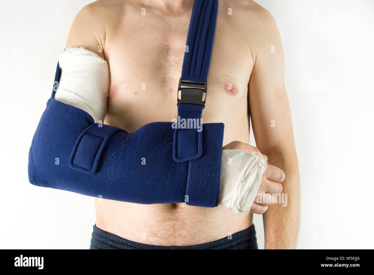 Hand mit Verband und Gips als Körperverletzung Konzept Stockfoto Hand mit Verband und Gips als Körperverletzung Konzept Stockfoto