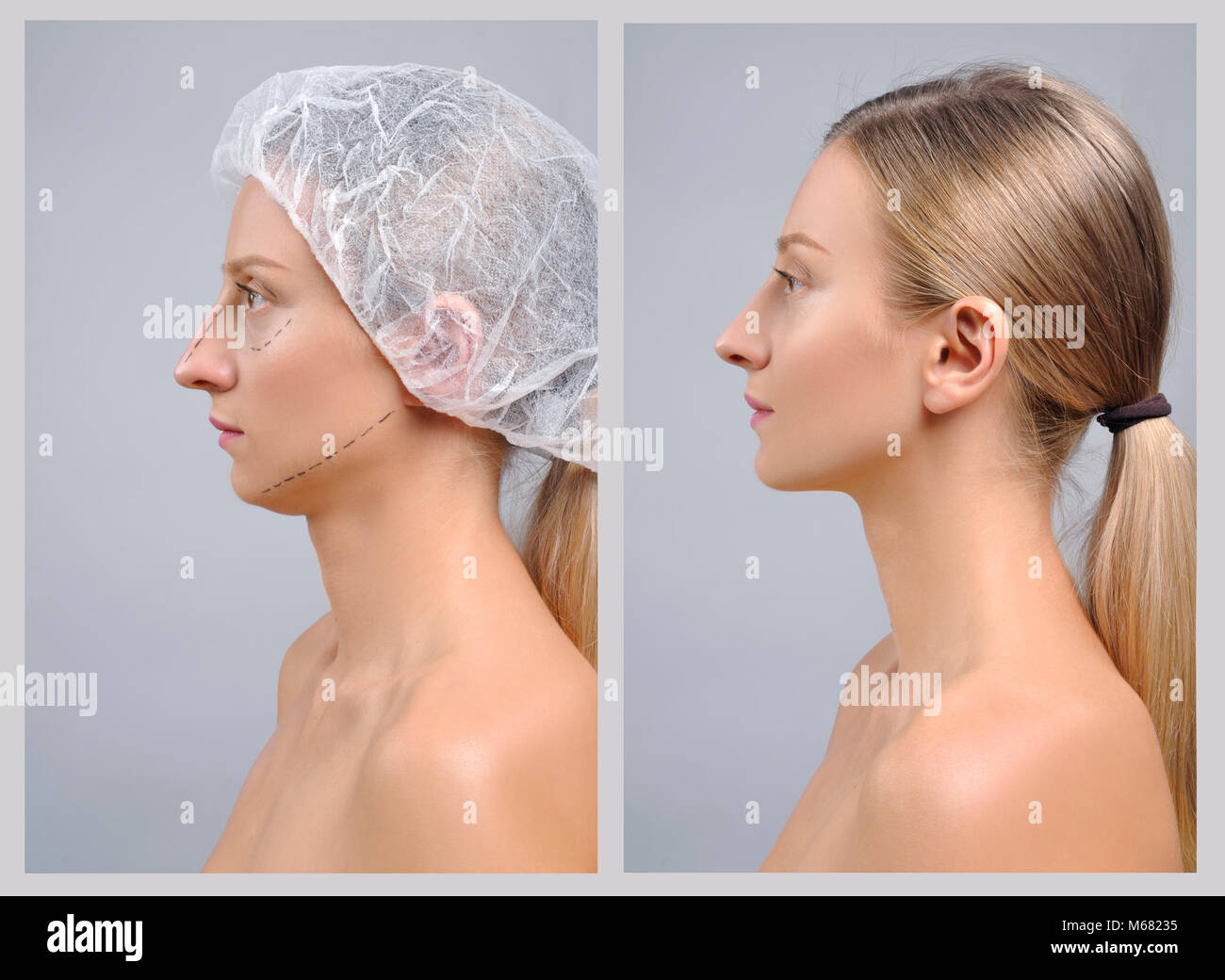 Rhinoplastik Portrat Des Weiblichen Gesichts Vor Und Nach Der Plastischen Chirurgie Der Nase Stockfotografie Alamy