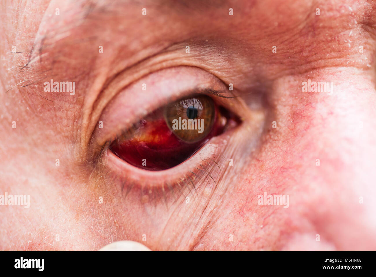 Bloodshot Auge durch einen Arbeitsunfall verursacht. Die Pupille ist ...