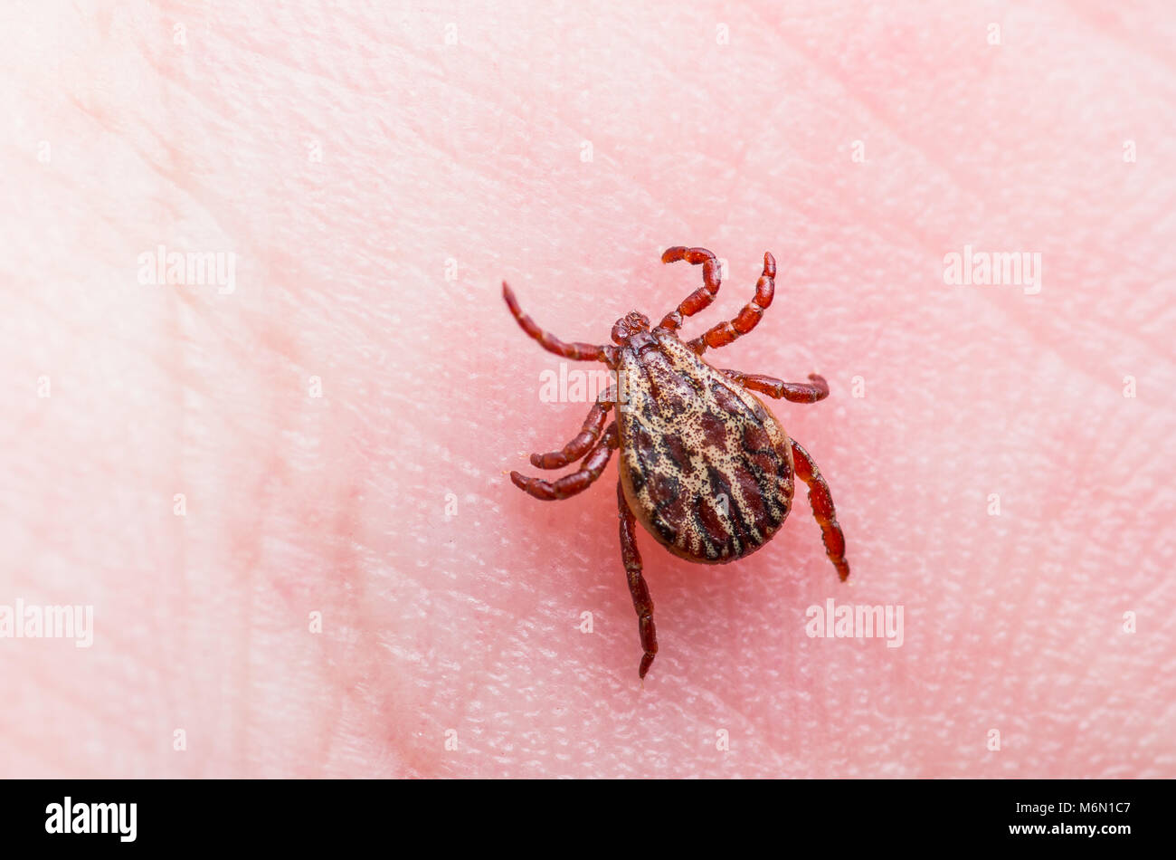Enzephalitis Virus oder Borreliose infizierte Zecke Spinne Insekt auf der Haut Stockfoto