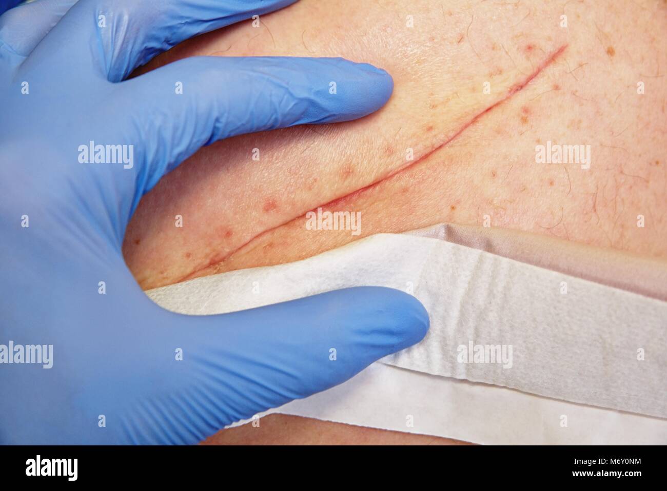 Verletzung Der Haut Mit Fünf Buchstaben www.alamy.de