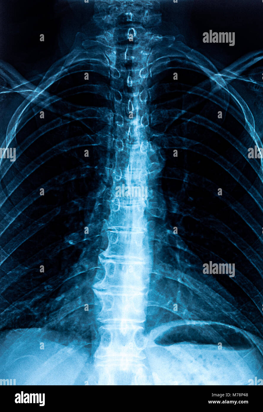 Frau Lendenwirbelsäule X-ray, unterer Rücken Prüfung Stockfoto
