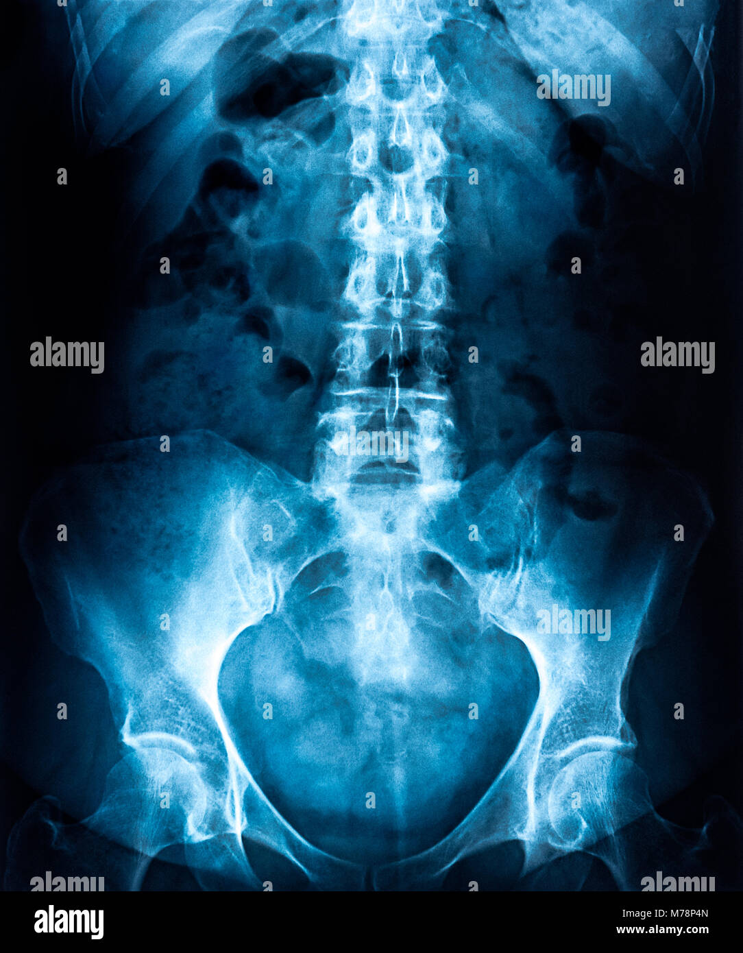 Frau Lendenwirbelsäule X-ray, unterer Rücken Prüfung Stockfoto