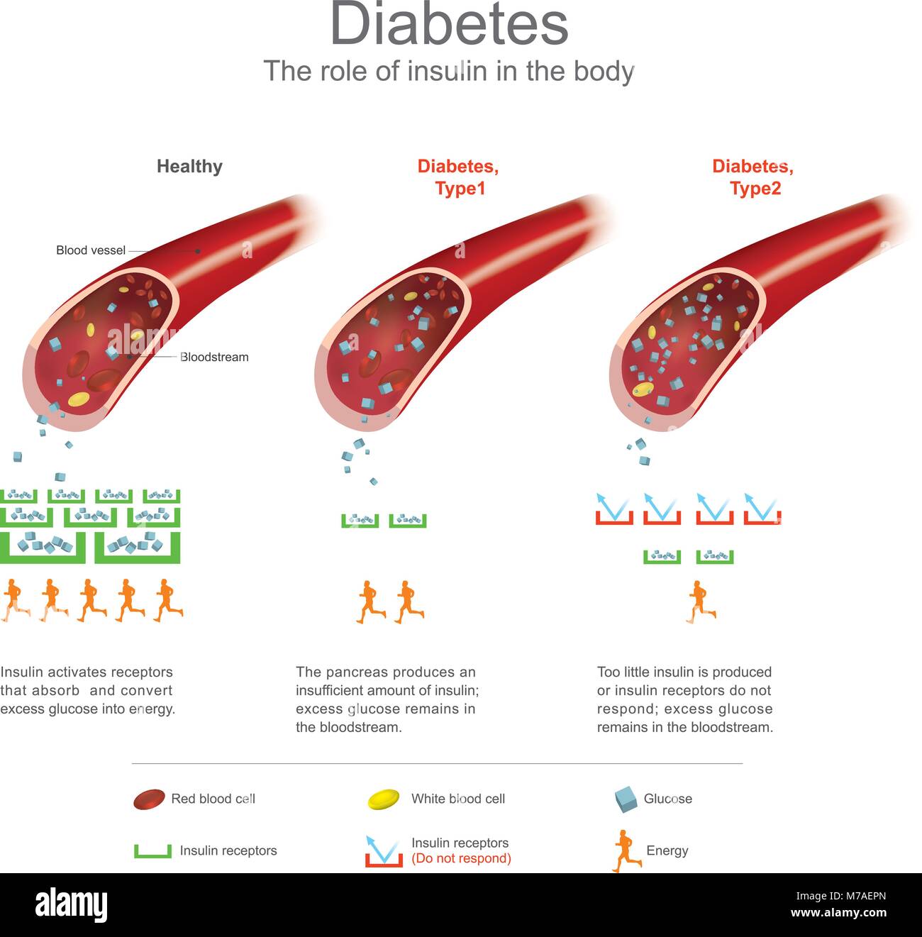 Symptome von hoher Blutzucker gehören häufiges Wasserlassen, erhöhter Durst und Hunger erhöht. Wenn Sie unbehandelt, kann Diabetes verursachen viele complicati Stock Vektor