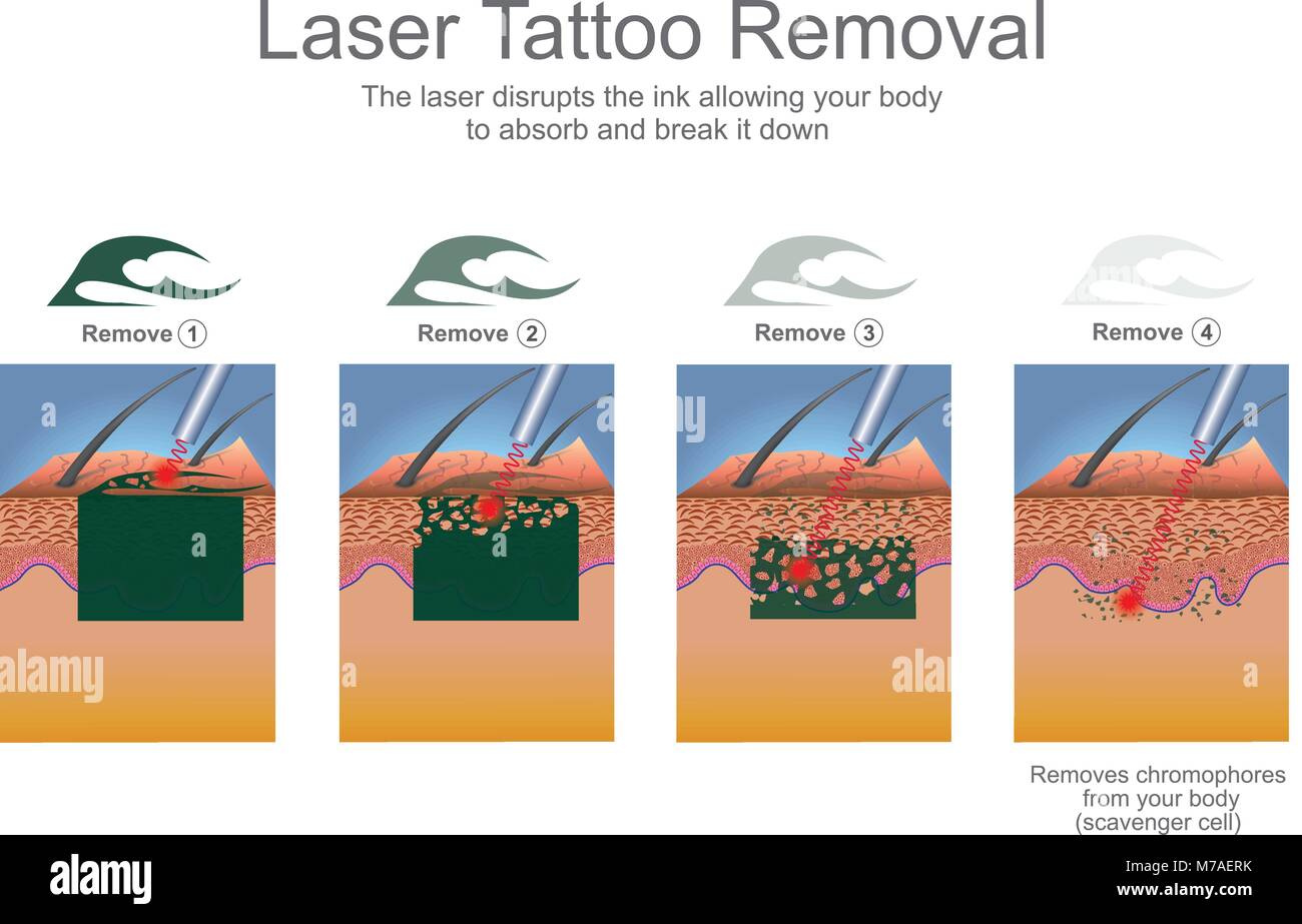 Tattoo Entfernung wird in der Regel mit Lasern, die die Tinte Partikel in der Tattoo Pause durchgeführt. Bildung Infografik. Vektor Design. Stock Vektor