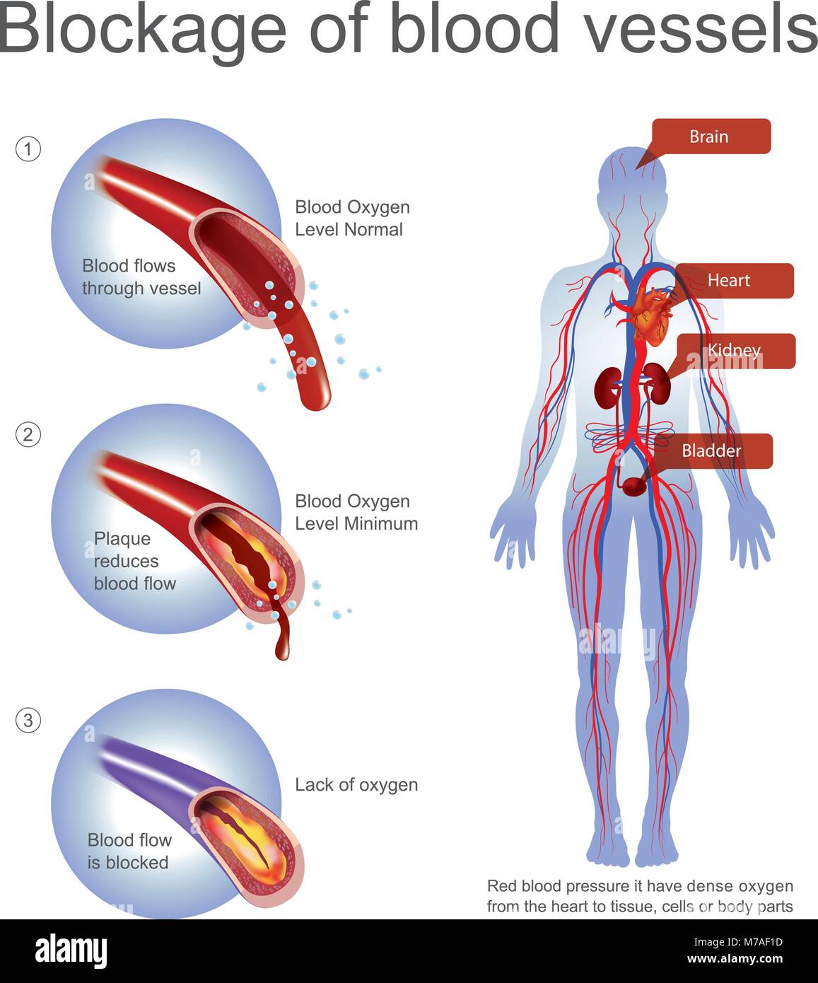 Rotes Blut Druck es dichten Sauerstoff aus dem Herzen zu Gewebe, Zellen oder Körperteile haben. Unbewusste es verursacht durch Blood Oxygen Level minimum oder Mangel an Stock Vektor Rotes Blut Druck es dichten Sauerstoff aus dem Herzen zu Gewebe, Zellen oder Körperteile haben. Unbewusste es verursacht durch Blood Oxygen Level minimum oder Mangel an Stock Vektor