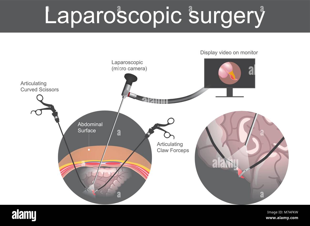 Laparoskopische Chirurgie. Technische Operation, welche Operationen weit von ihrem Standort durch kleine Schnitte in die Abdominal- Oberfläche oder der Bsb durchgeführt werden Stock Vektor