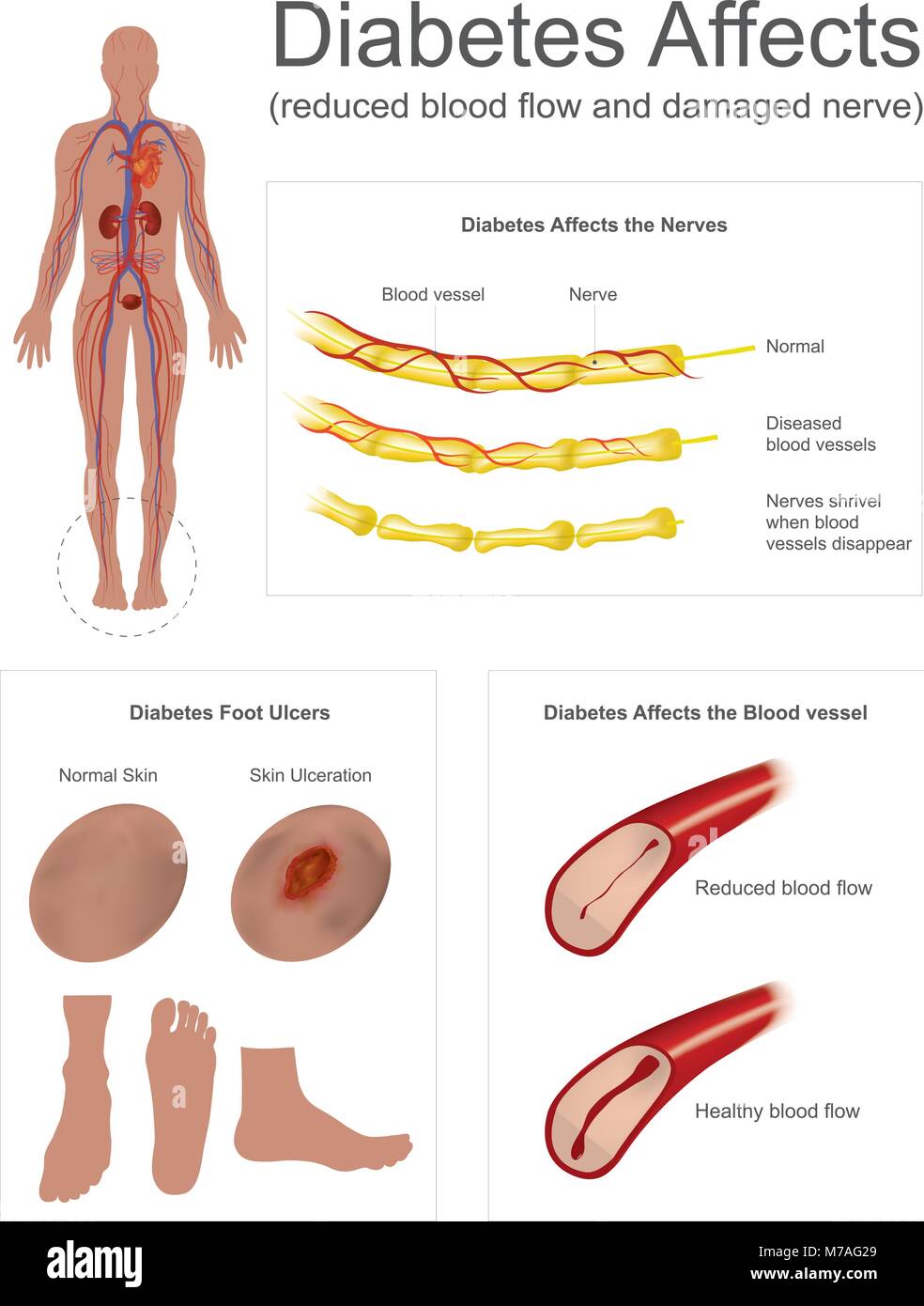 Die Nerven im Bein verkümmern, wenn Blutgefäße verschwinden. Ulcera sind eine häufige Komplikation schlecht kontrollierter Diabetes. Info Grafik Vektor. Stock Vektor