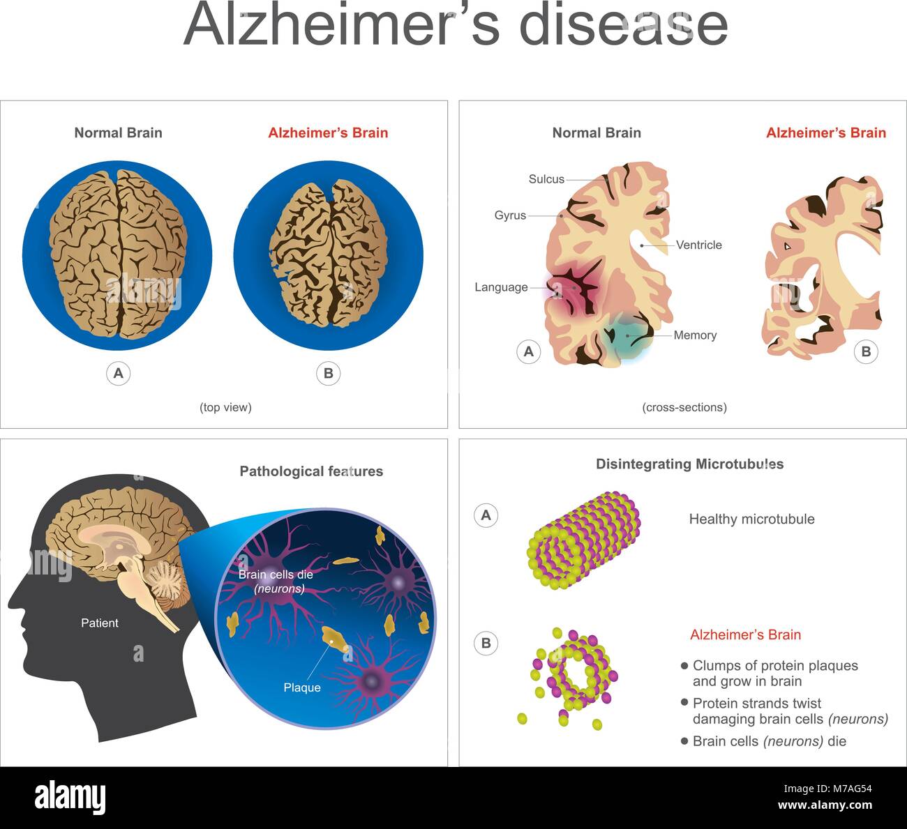 Gehirnzellen sterben, Neuron erkrankten, bestimmte Bereiche des Gehirns Gedächtnisverlust oder Änderungen im Speicher für Menschen im Alter von 65 Jahren und bis in Gefahr Jüngere könnte Schwund Stock Vektor