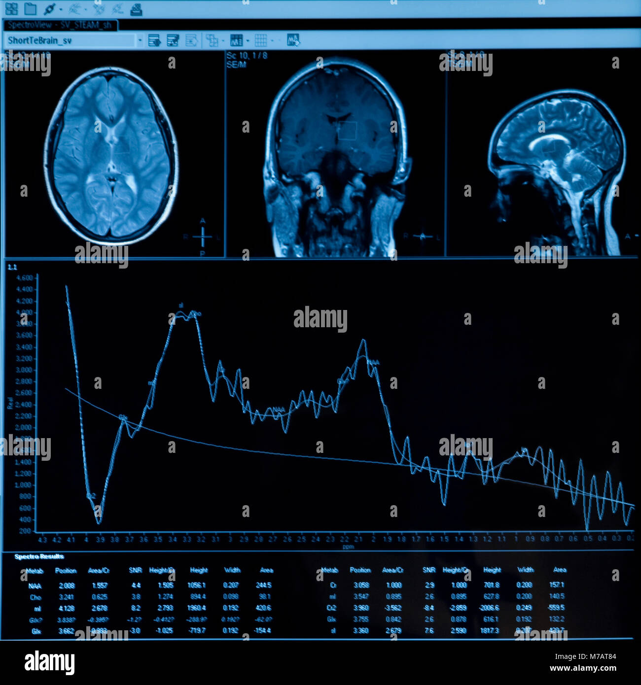 Nahaufnahme von MRI-Scan-Bericht Stockfoto