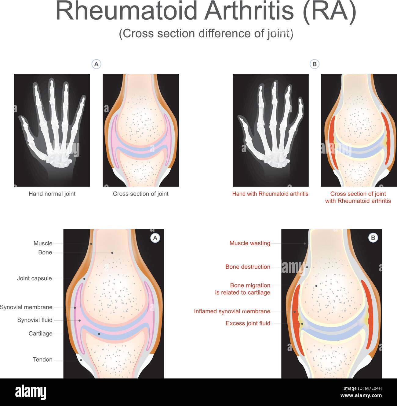 Die rheumatoide Arthritis ist eine chronische entzündliche Erkrankung, die mehr als nur ihre Gelenke auswirken können. Info Grafik Vektor. Stock Vektor