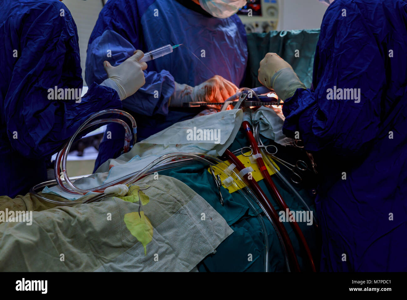 Offenes Herz Herz Bypass Chirurgie in Betrieb zimmer Ärzte Team Wear blue coat Herzchirurgie am Op durchführen Stockfoto