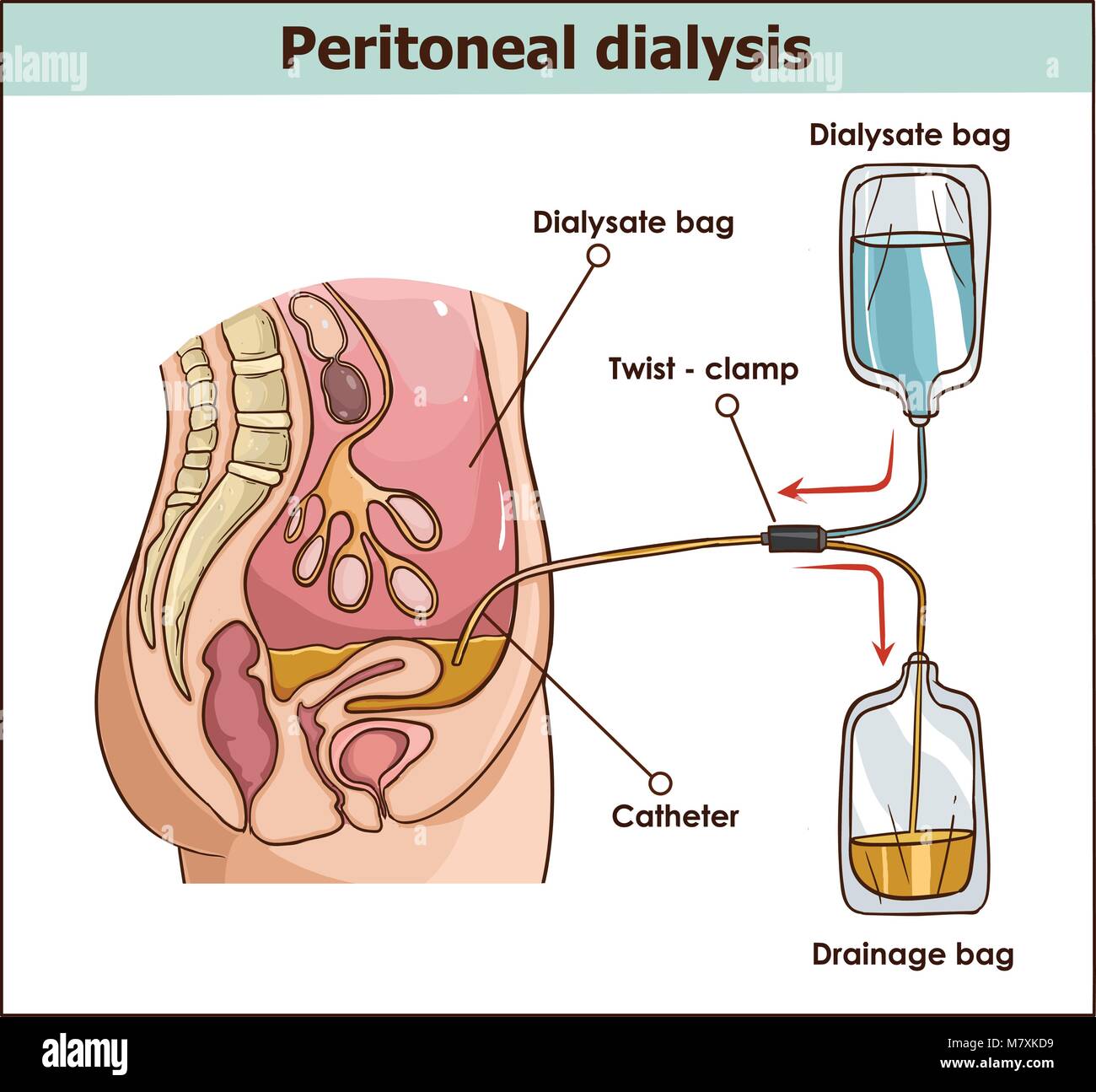 Peritonealdialyse sind beide Nieren-Vector Illustration zu behandeln. Stock Vektor