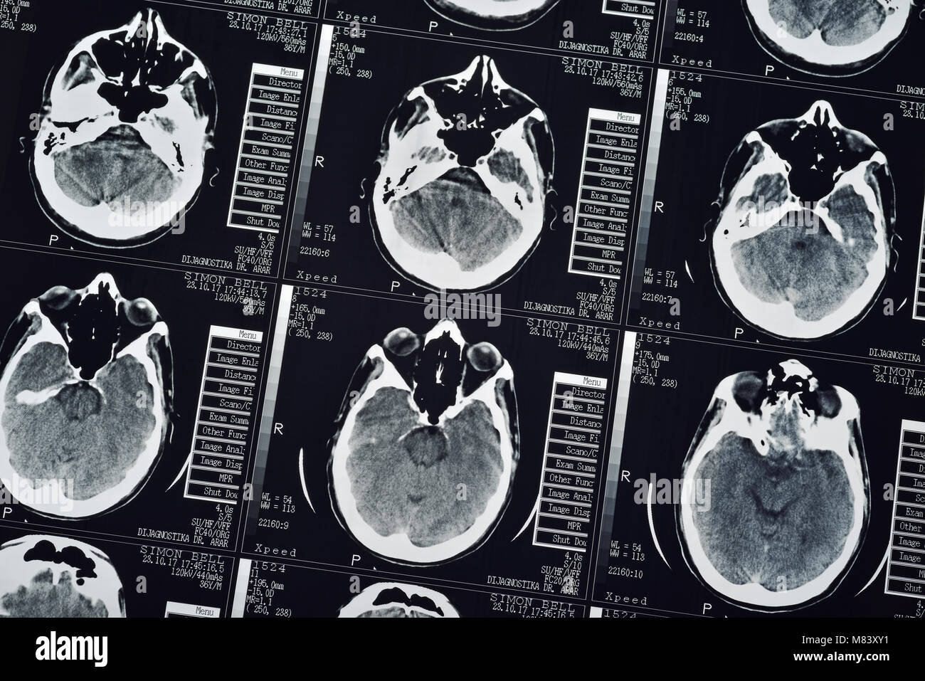 CT-Scan eines menschlichen männlichen Gehirn, Nahaufnahme Stockfoto