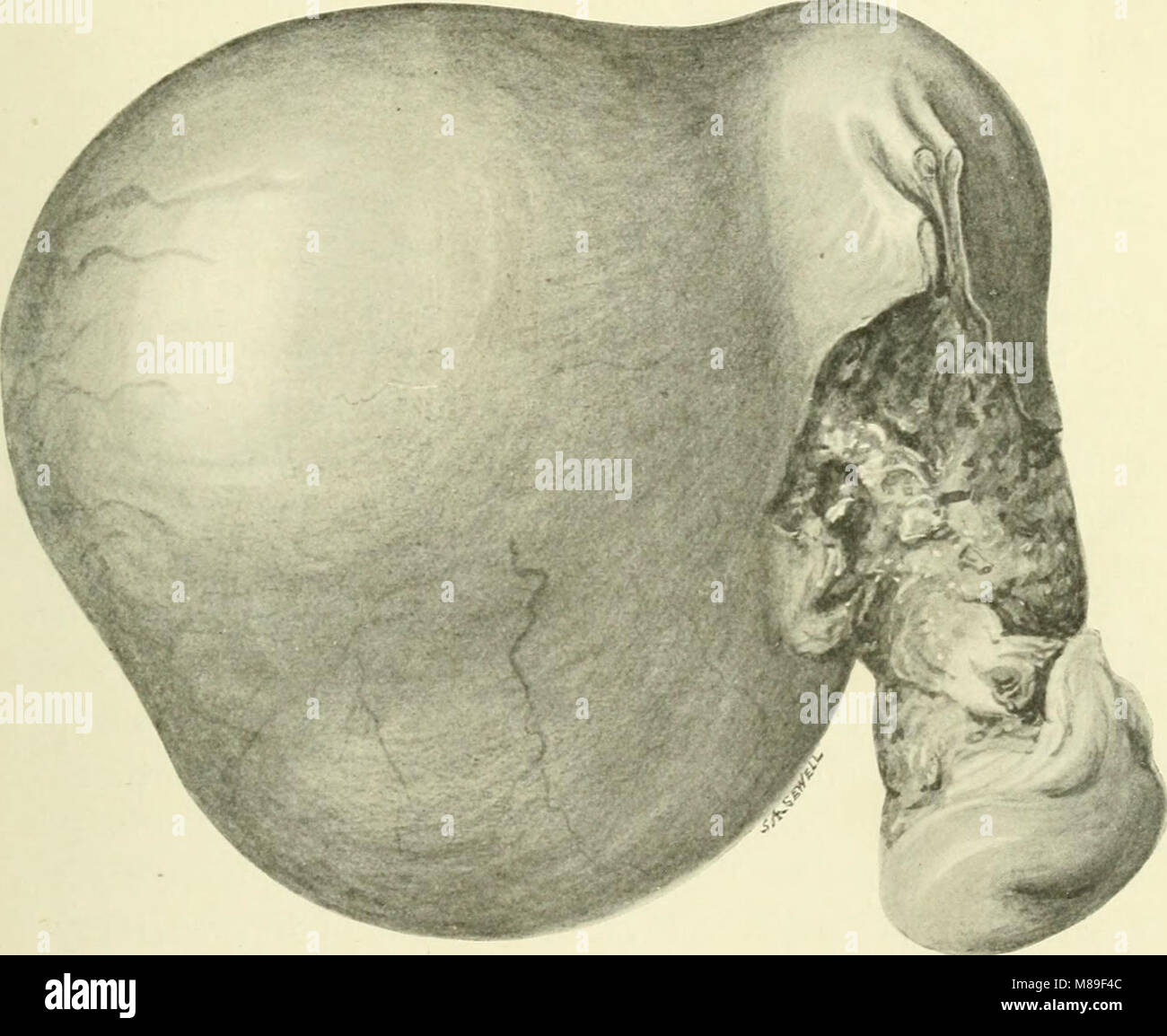 Myome und alliierten Tumoren (Myome und adenomyoma) - ihre Pathologie, klinische Merkmale und chirurgische Behandlung (1918) (14757631416) Stockfoto