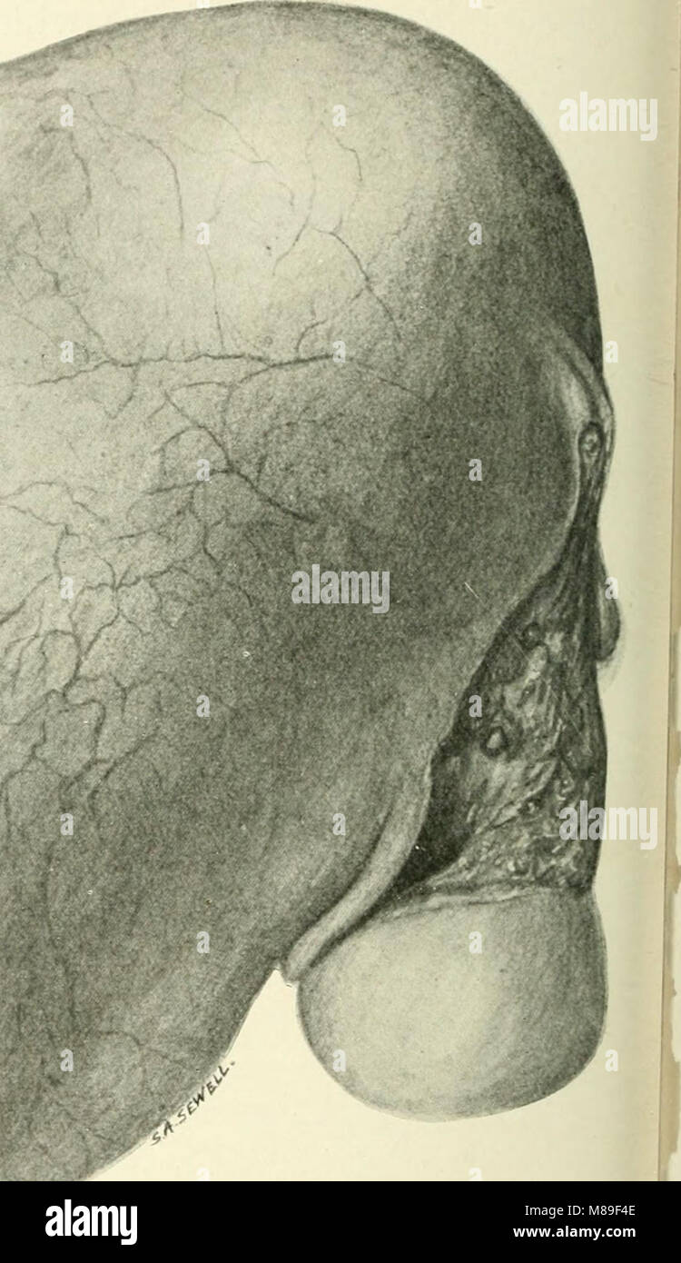 Myome und alliierten Tumoren (Myome und adenomyoma) ihre Pathologie