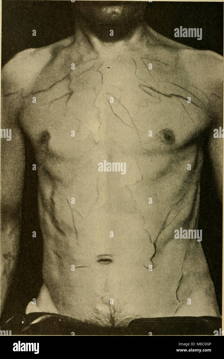 Erkrankungen des Herzens und der arteriellen System; eine praktische Präsentation des Themas für die Verwendung von Studenten und Praktiker der Medizin (1910) (14582591999) Stockfoto
