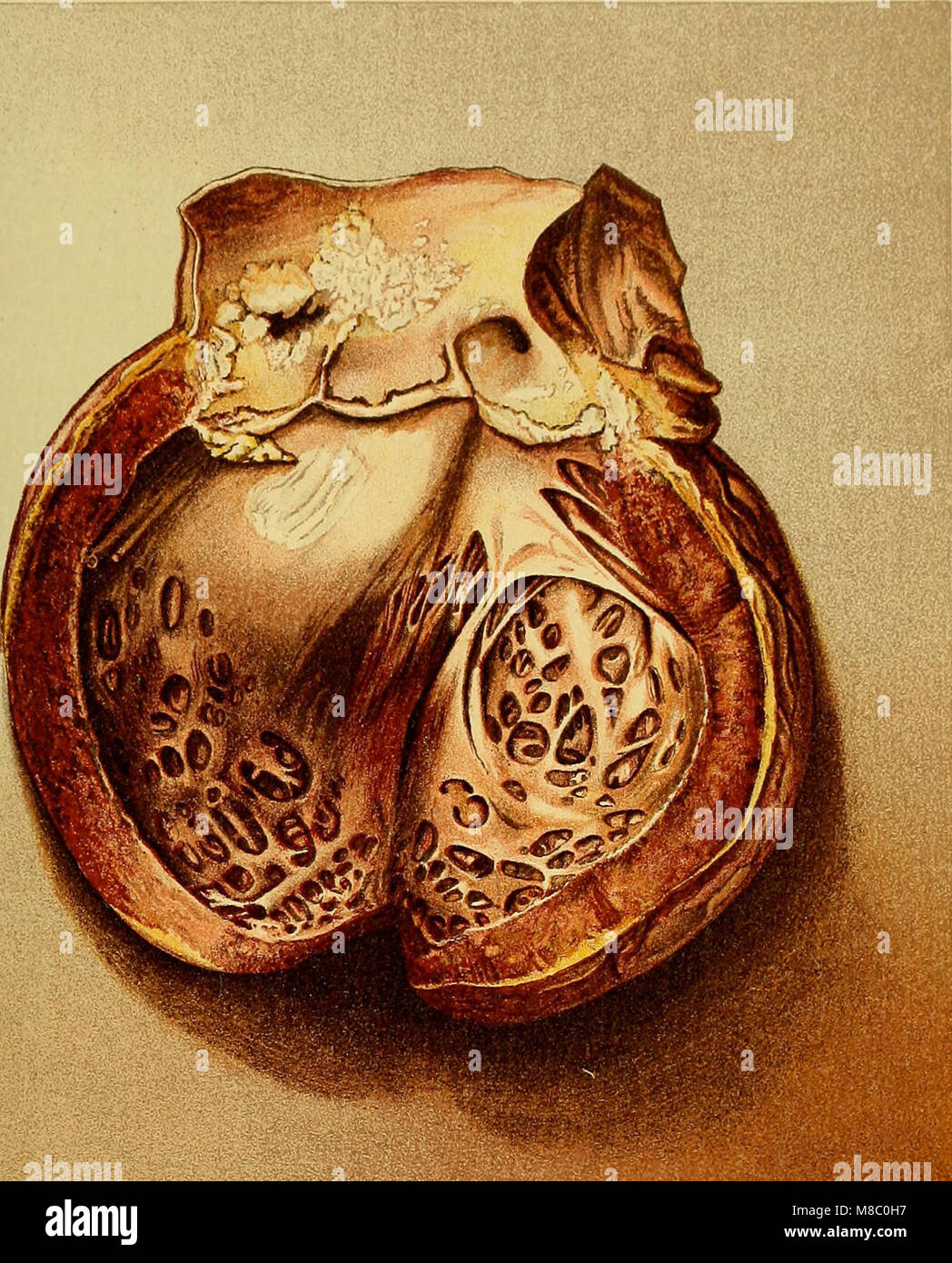 Erkrankungen des Herzens und der arteriellen System - eine praktische Präsentation des Themas für die Verwendung von Studenten und Praktiker der Medizin (1907) (14796147063) Stockfoto