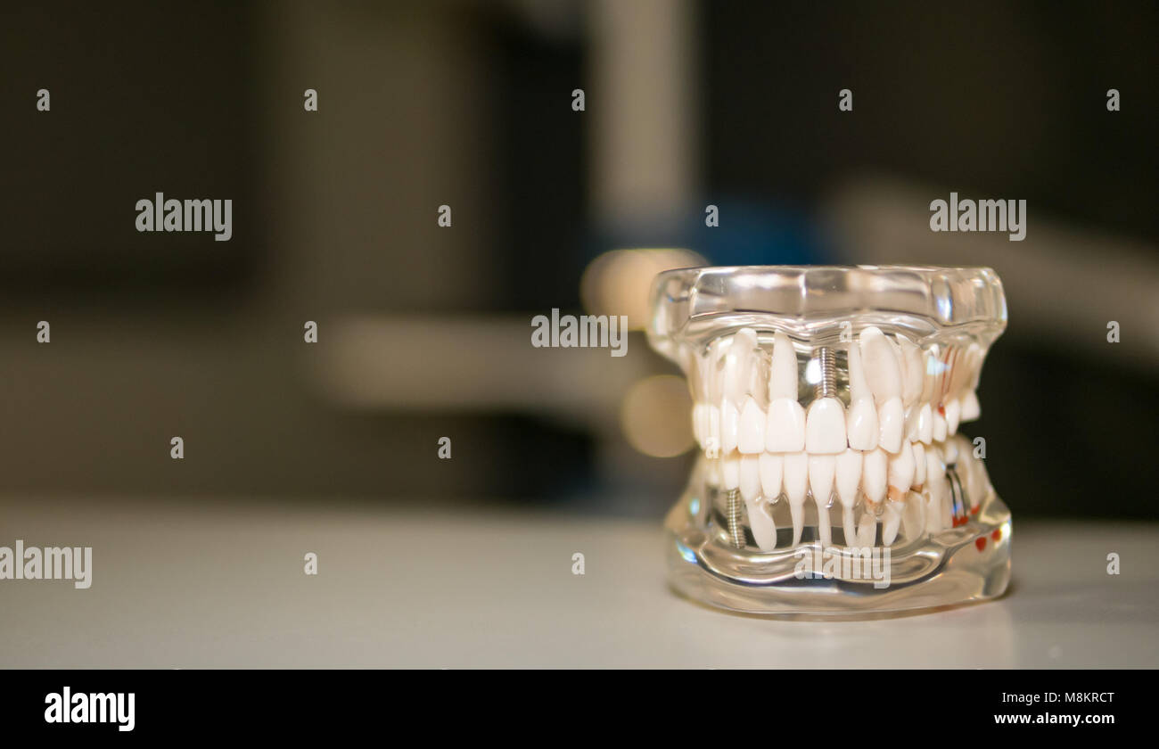 Nahaufnahme eines Ober- und Unterkiefer Modell in der Zahnheilkunde als Lehrmittel eingesetzt. Modell zeigt Implantate und erkrankte Zähne. Stockfoto