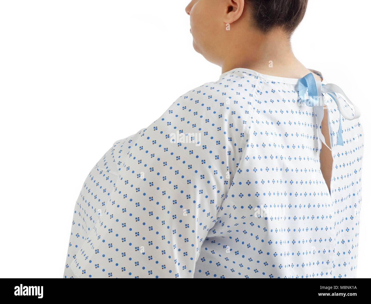 Übergewichtige Frau im Krankenhaus Kleid, Ansicht von hinten. Stockfoto