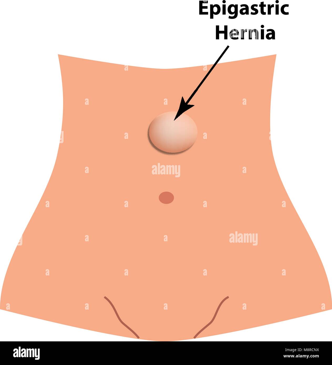 Eine epigastrischen Hernie. intestinale Hernie. Infografiken. Vector Illustration auf isolierte Hintergrund Stock Vektor