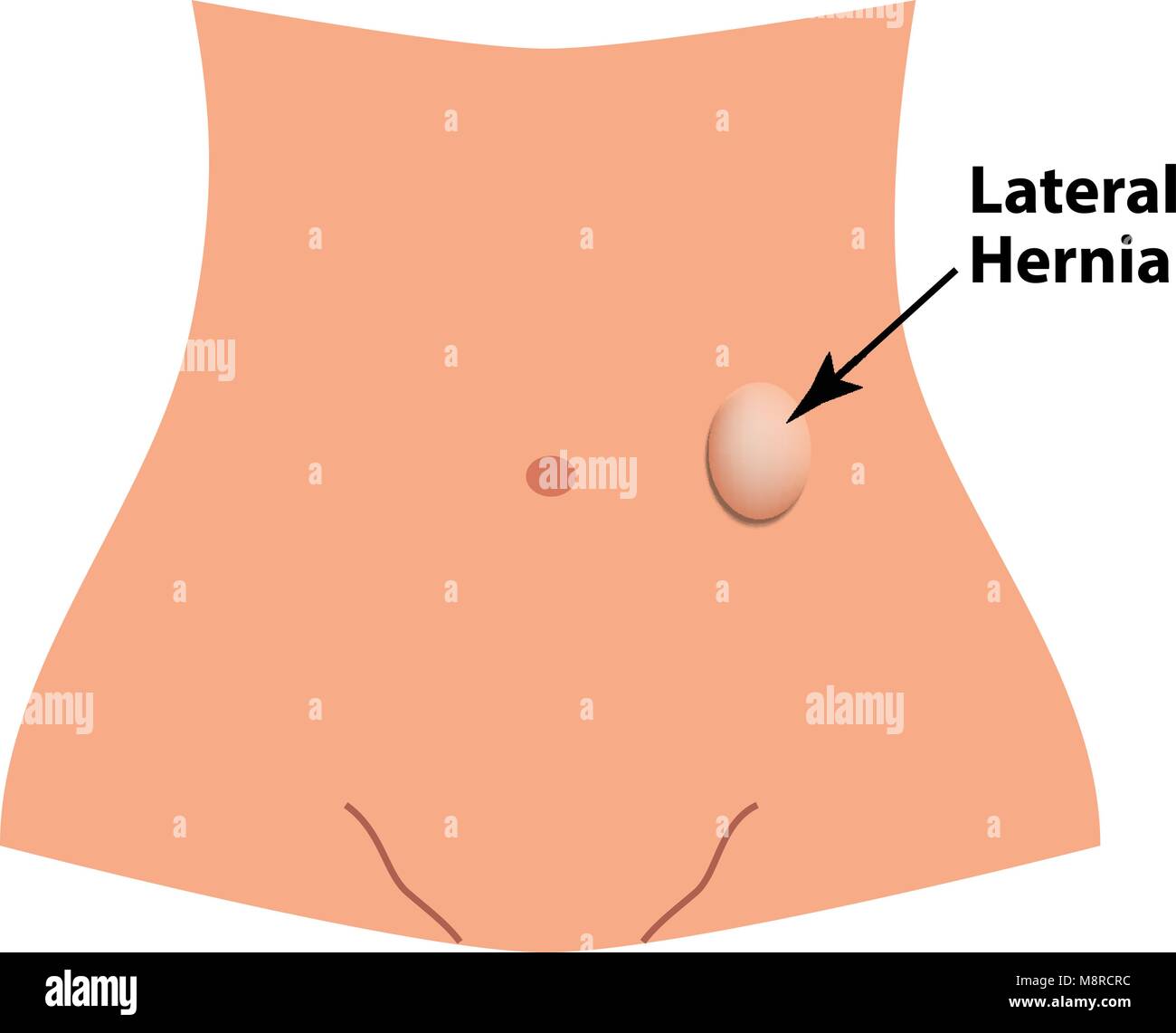 Seitliche Herniation. intestinale Hernie. Infografiken. Vector Illustration auf isolierte Hintergrund. Stock Vektor