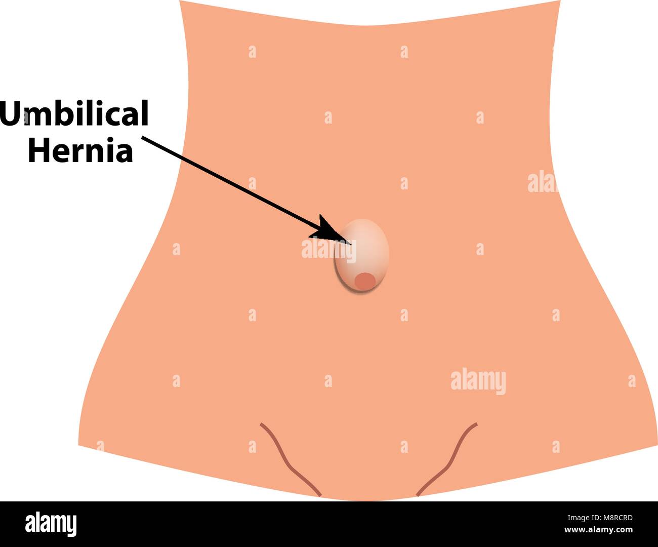 Nabelbruch. intestinale Hernie. Infografiken. Vector Illustration auf isolierte Hintergrund. Stock Vektor