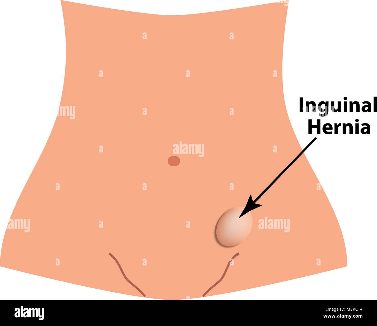 Leistenbruch. intestinale Hernie. Infografiken. Vector Illustration auf isolierte Hintergrund. Stock Vektor