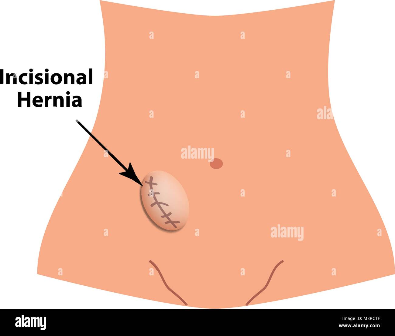 Incisional hernia. intestinale Hernie. Infografiken. Vector Illustration auf isolierte Hintergrund. Stock Vektor