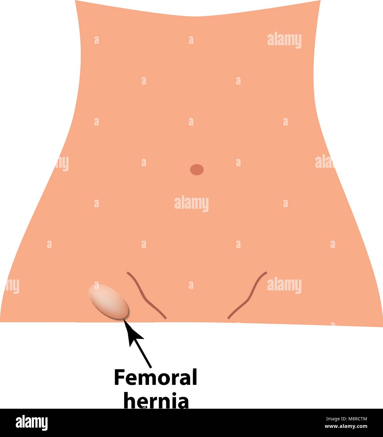 Femoral Hernie. intestinale Hernie. Infografiken. Vector Illustration auf isolierte Hintergrund. Stock Vektor