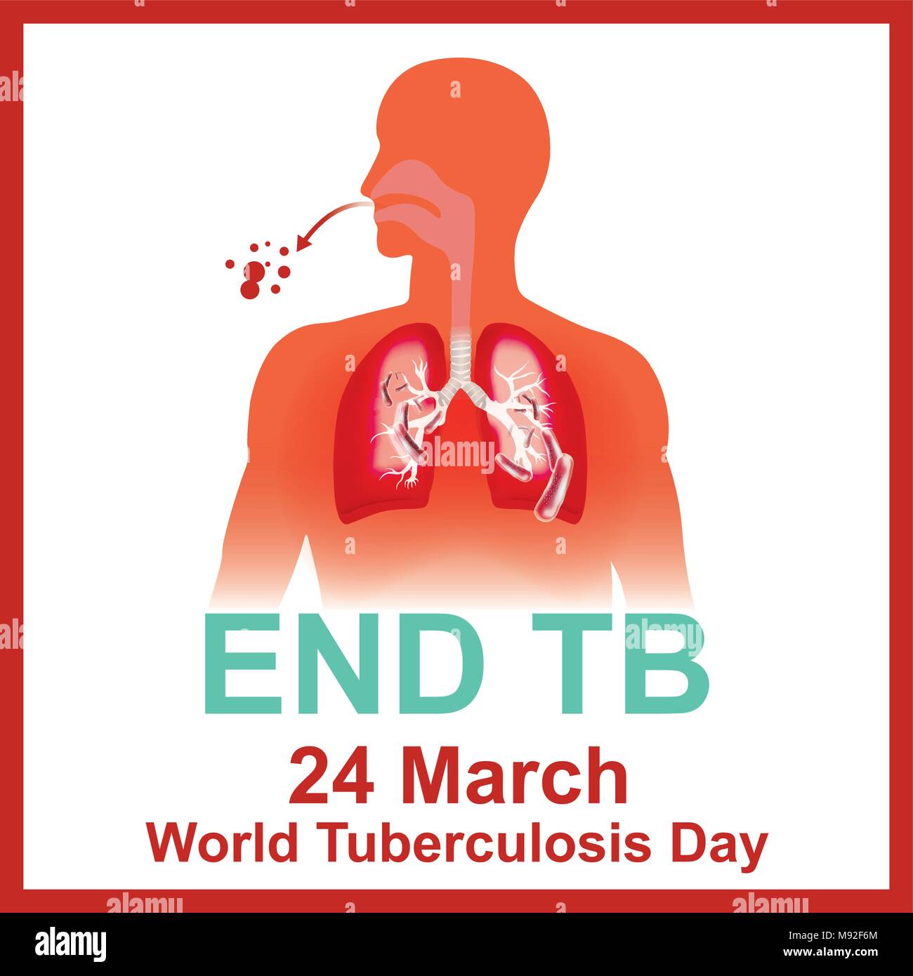 Patienten mit Infektionen der Atemwege. Durch Tuberkulose Bakterien verursacht. Tuberkulose Bakterien biss das Gewebe, was zu Lecks von Blutgefäßen. Il Stock Vektor