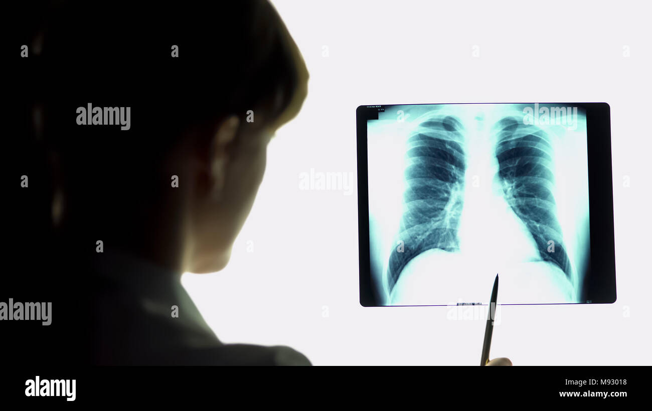 Therapeut Analyse Pneumonie Lunge Röntgenbild, Schlussfolgerungen, Gesundheitswesen Stockfoto
