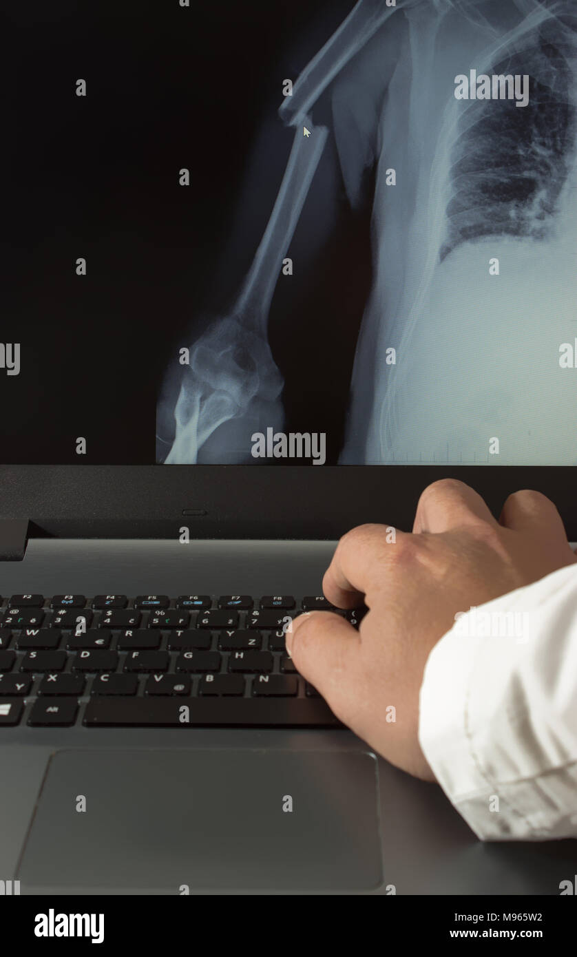 Arzt die Prüfung eines X-ray Bild eines gebrochenen Arm auf einem Laptop Bildschirm Stockfoto