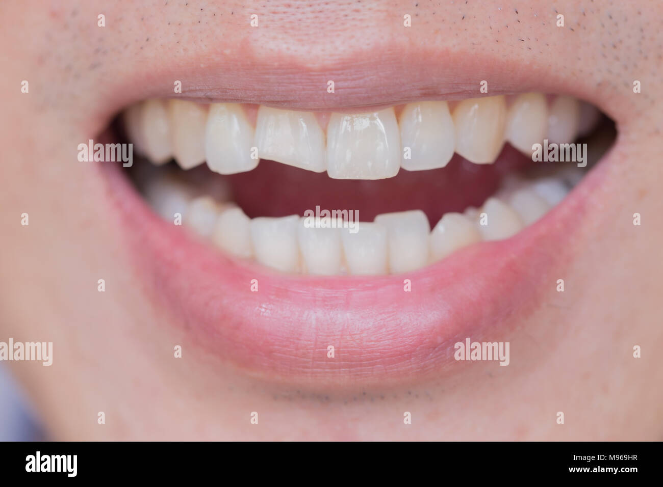 Verletzungen der Zähne oder Zähne bei männlichen Brechen. Trauma und Nervenschäden der verletzten Zahn, bleibenden Zähne Verletzungen. Stockfoto