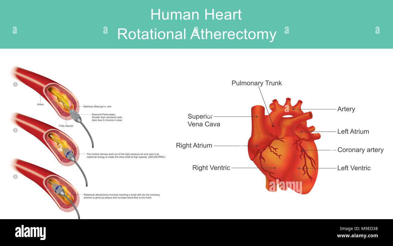 Atherectomy ist ein Verfahren, das durchgeführt wird, um atherosklerotischen Plaque aus erkrankten Arterien zu entfernen. Arteriosklerotische Plaques sind entweder lokalisiert. Stock Vektor