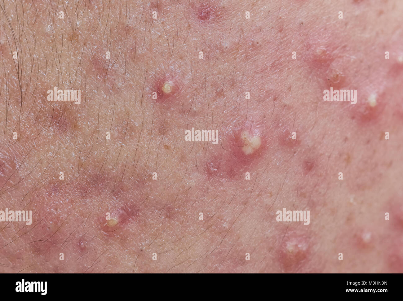 Akne auf der Gesichtshaut, dermatologische Erkrankungen Akne Stockfoto