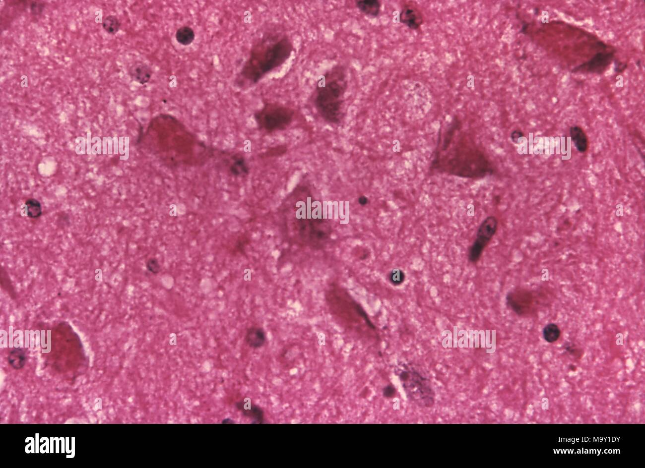 Zelluläre Veränderungen im Zusammenhang mit Tollwut Enzephalitis, in der mit H und E-Färbung, 1971 photomicrograph offenbart. Mit freundlicher Seuchenkontrollzentren (CDC)/Dr Daniel P Perl. Mit freundlicher CDC. () Stockfoto