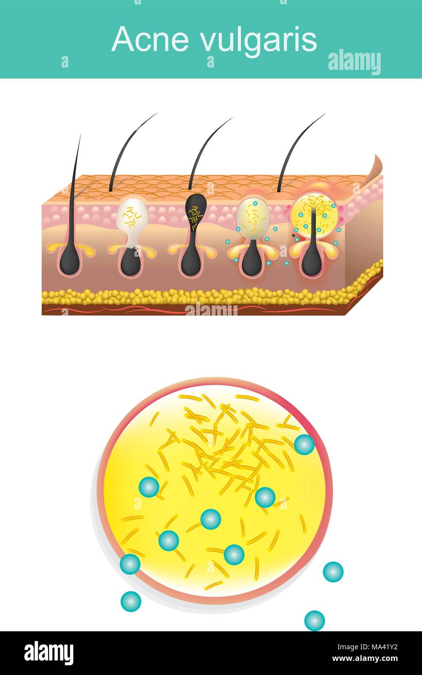 Akne vulgarise ist eine langfristige Erkrankung der Haut, die auftritt, wenn Haarfollikel und abgestorbene Hautzellen und Öl aus Haut verstopft werden. Akne ist charakterisieren Stock Vektor