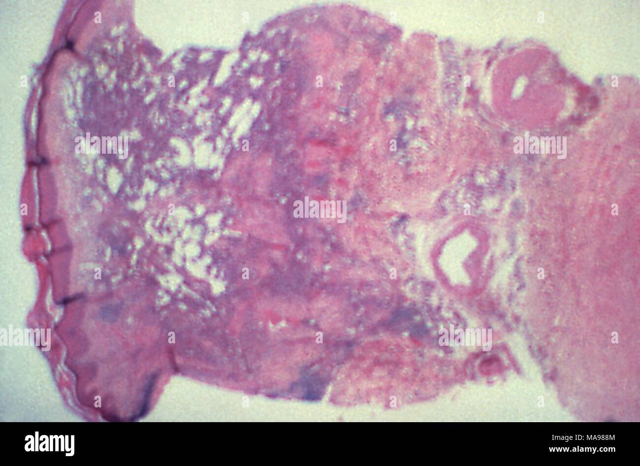 Kaposi-sarkom in der menschlichen Haut in der niedrigen Vergrößerung photomicrograph Film, 1983 aufgedeckt. Mit freundlicher Seuchenkontrollzentren (CDC)/Dr Peter Drotman. () Stockfoto