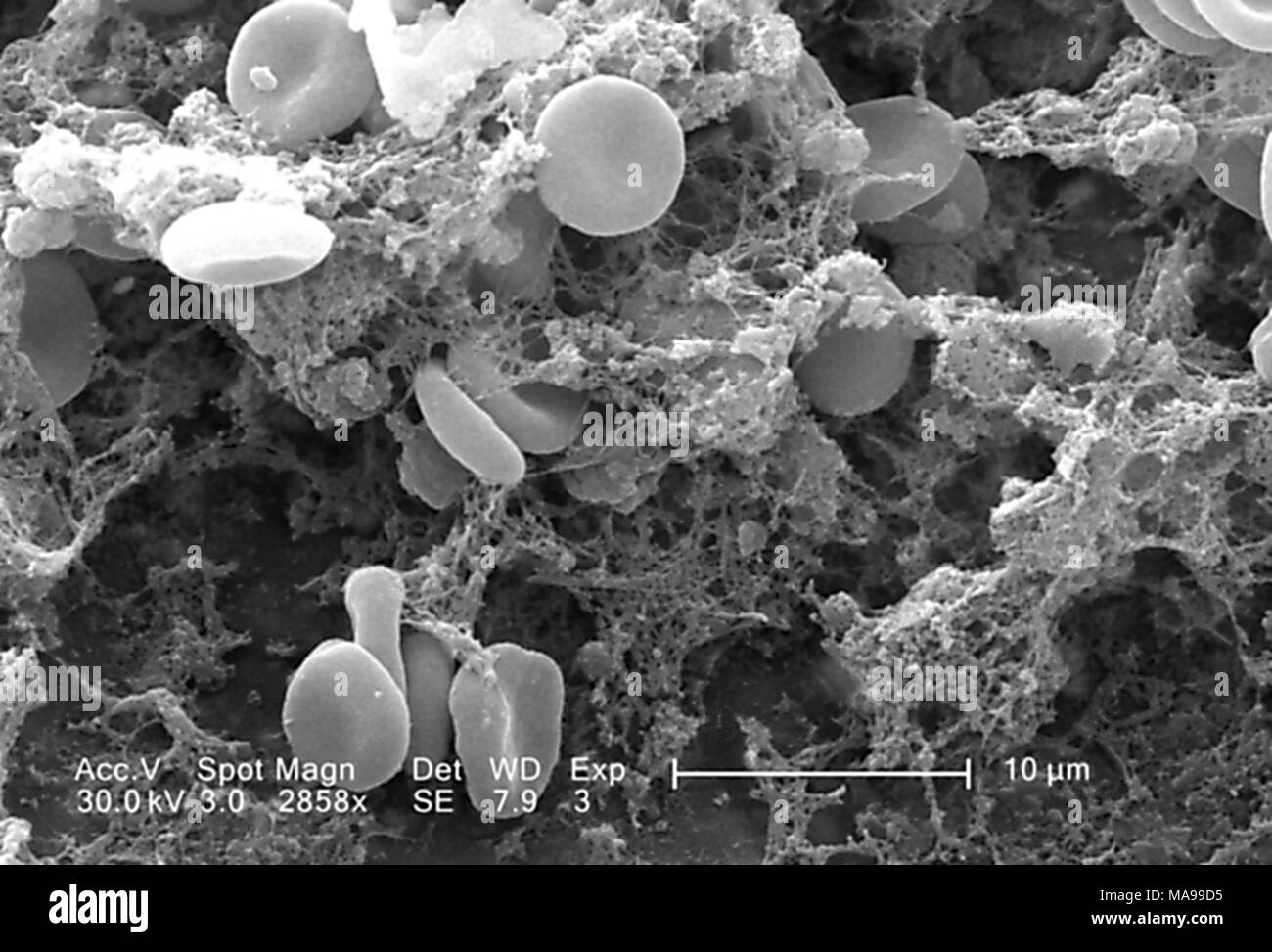 Die roten Blutkörperchen in einem Fibrinöse Matrix auf der luminalen Oberfläche eines Innewohnung Kreislauf-katheter im Raster-Elektronen-Mikroskop (REM) Bild 2005 aufgedeckt. Mit freundlicher Seuchenkontrollzentren (CDC)/Janice Haney Carr. () Stockfoto