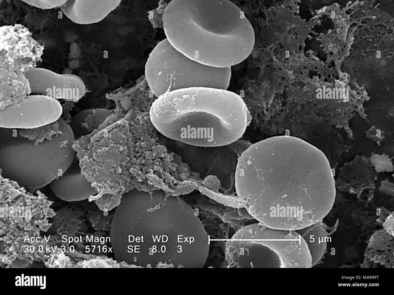 Die roten Blutkörperchen in einem Fibrinöse Matrix auf der luminalen  Oberfläche eines Innewohnung Kreislauf-katheter im Raster-Elektronen- Mikroskop (REM) Bild 2005 aufgedeckt. Mit freundlicher  Seuchenkontrollzentren (CDC)/Janice Haney Carr ...
