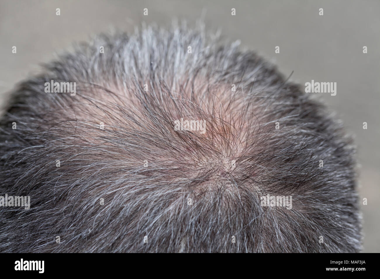 Ein Mann im mittleren Alter beginnt die Haare auf seinem Kopf zu verlieren. Stockfoto