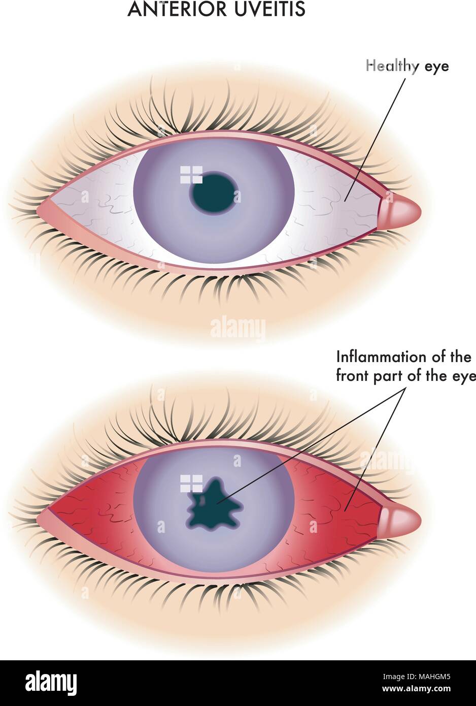 Medizinische Illustration der Symptome einer Uveitis anterior Stock Vektor