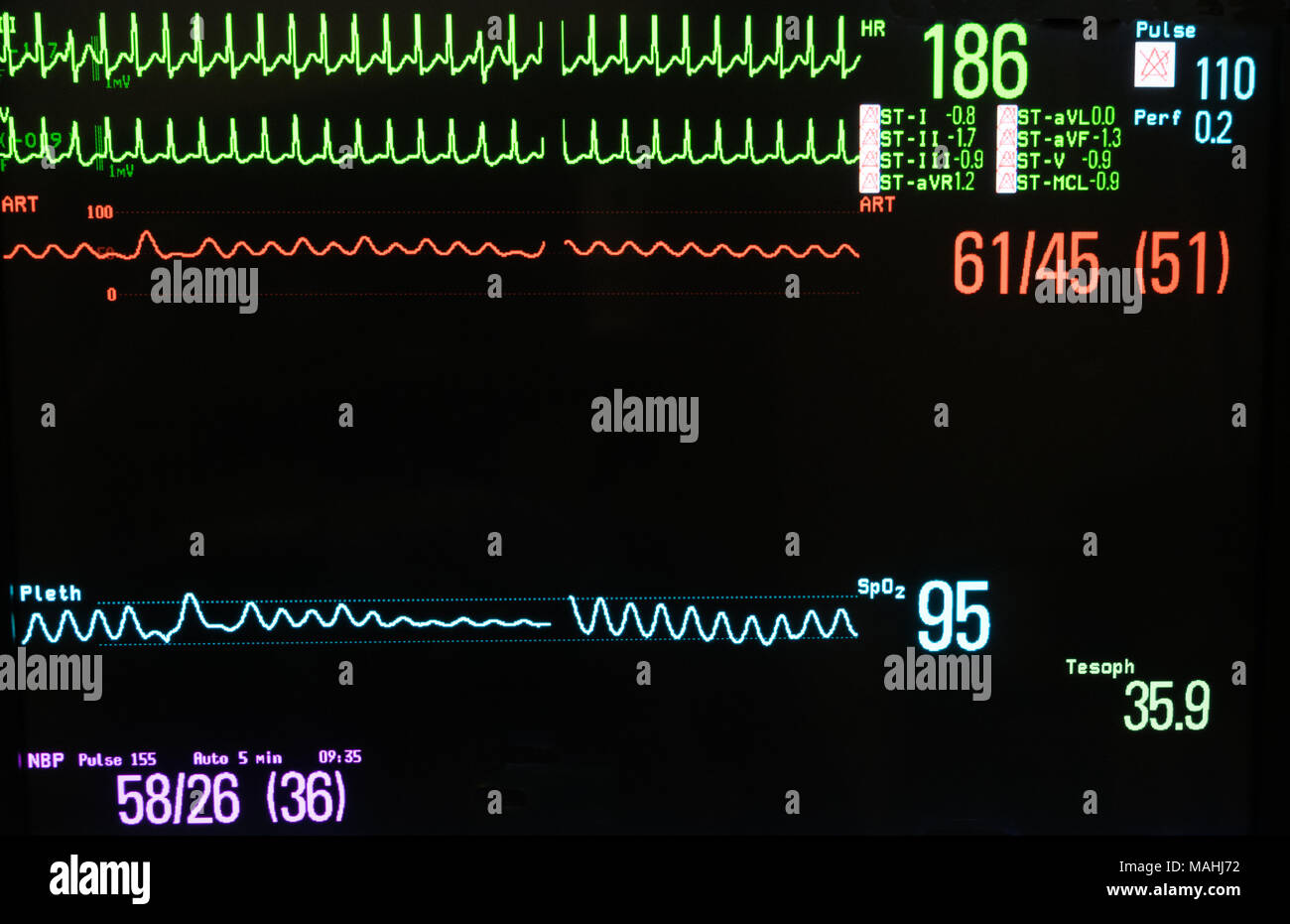 Monitor supraventrikuläre Tachykardie in Grün, arterieller Blutdruck in Rot, in blau Pulsoxymetrie, nichtinvasive Blutdruckmessung in Lavendel Stockfoto
