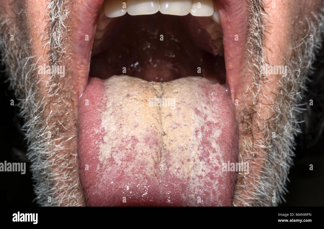 Creme weiße Beschichtung auf der Zunge Stockfoto