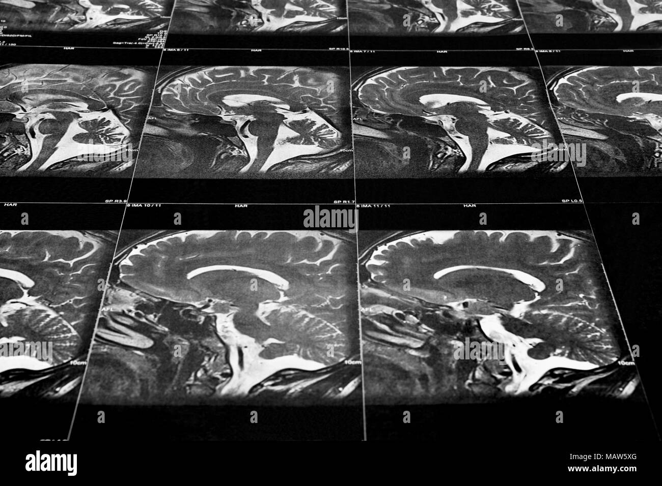Perspektivische Ansicht eines MRT-Scan des Gehirns (sagittale Ansicht) Stockfoto