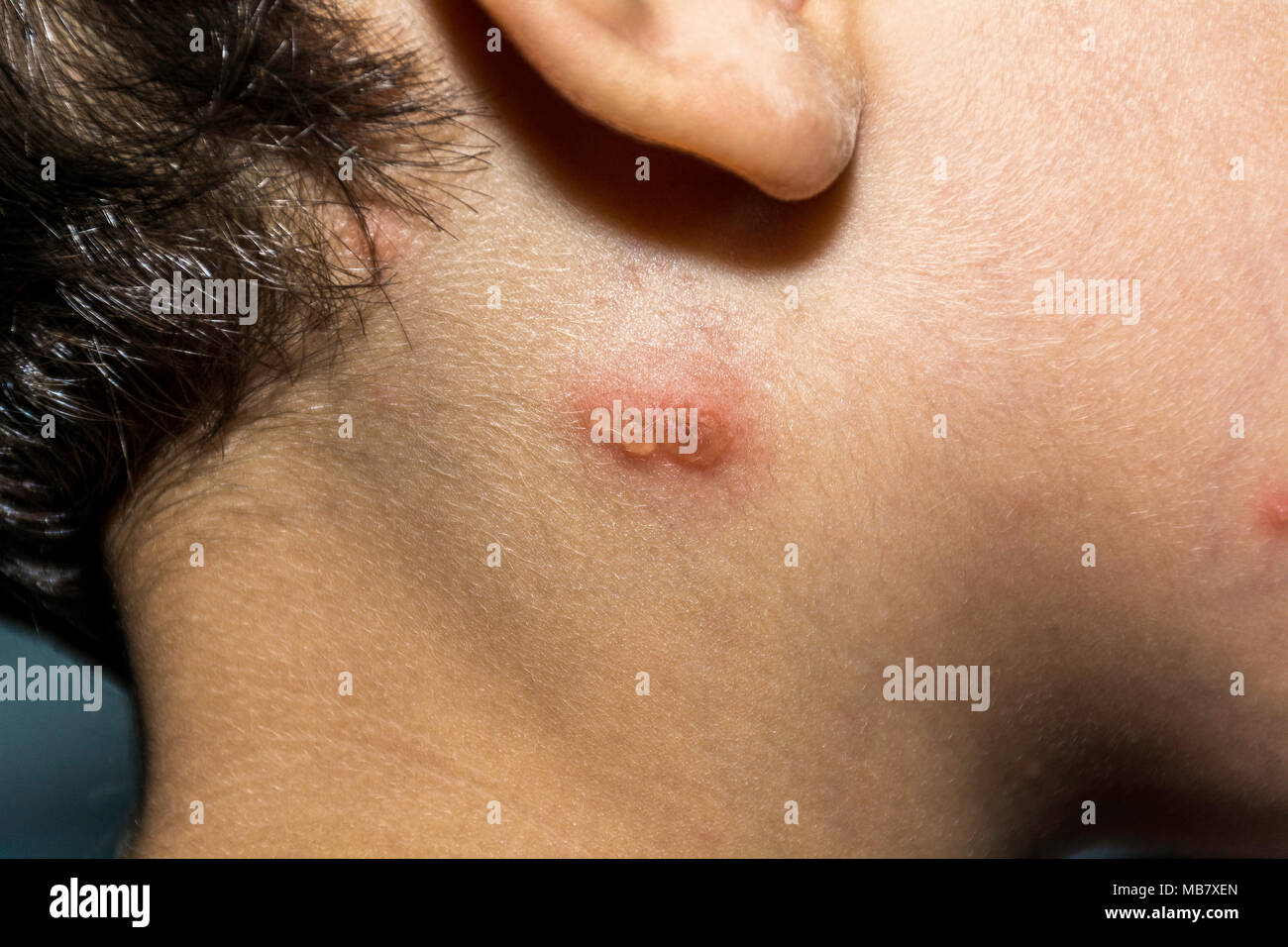 Nahaufnahme von Varicella-zoster Virus oder Windpocken bubble Hautausschlag im Gesicht und Hals des Kindes. Dermatologie Begriff. Stockfoto